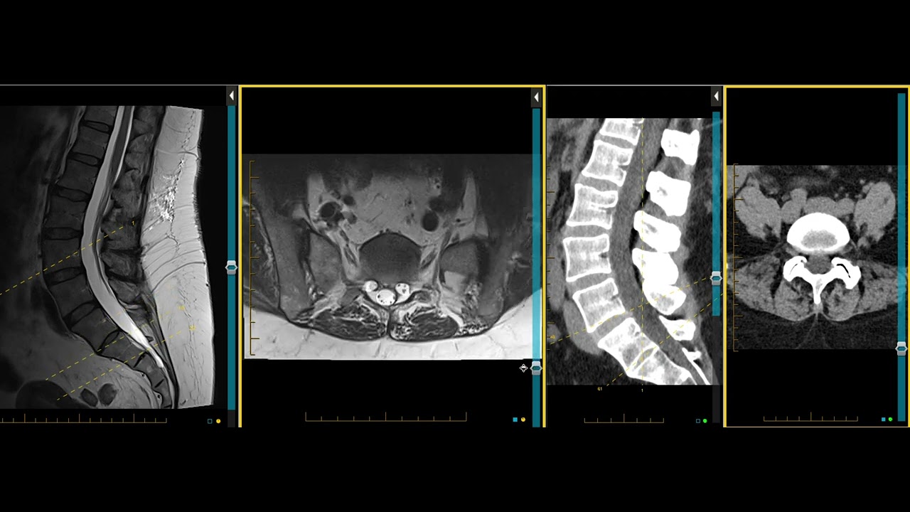 Multifidus muscle atrophy - CT and MRI comparison and the clinical progression in low back pain