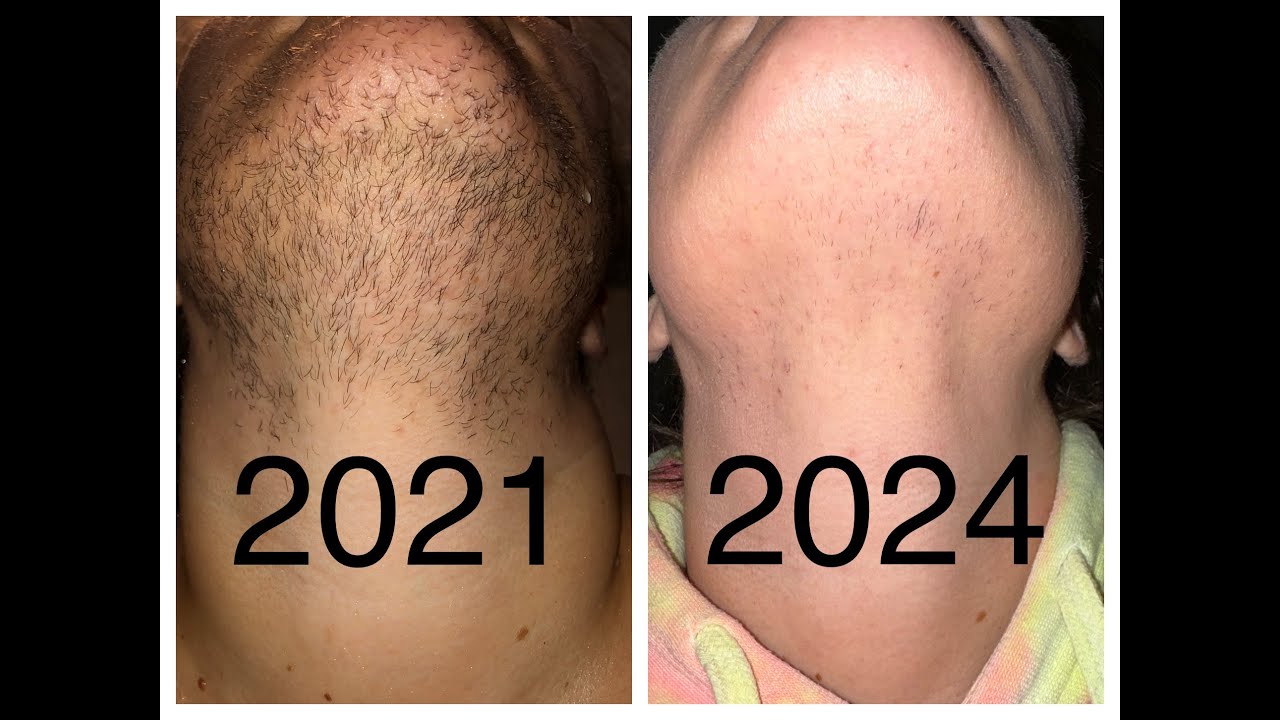 147 hours Electrolysis Hair Removal | Permanent Facial Hair Removal Expectations | PCOS Hirsutism