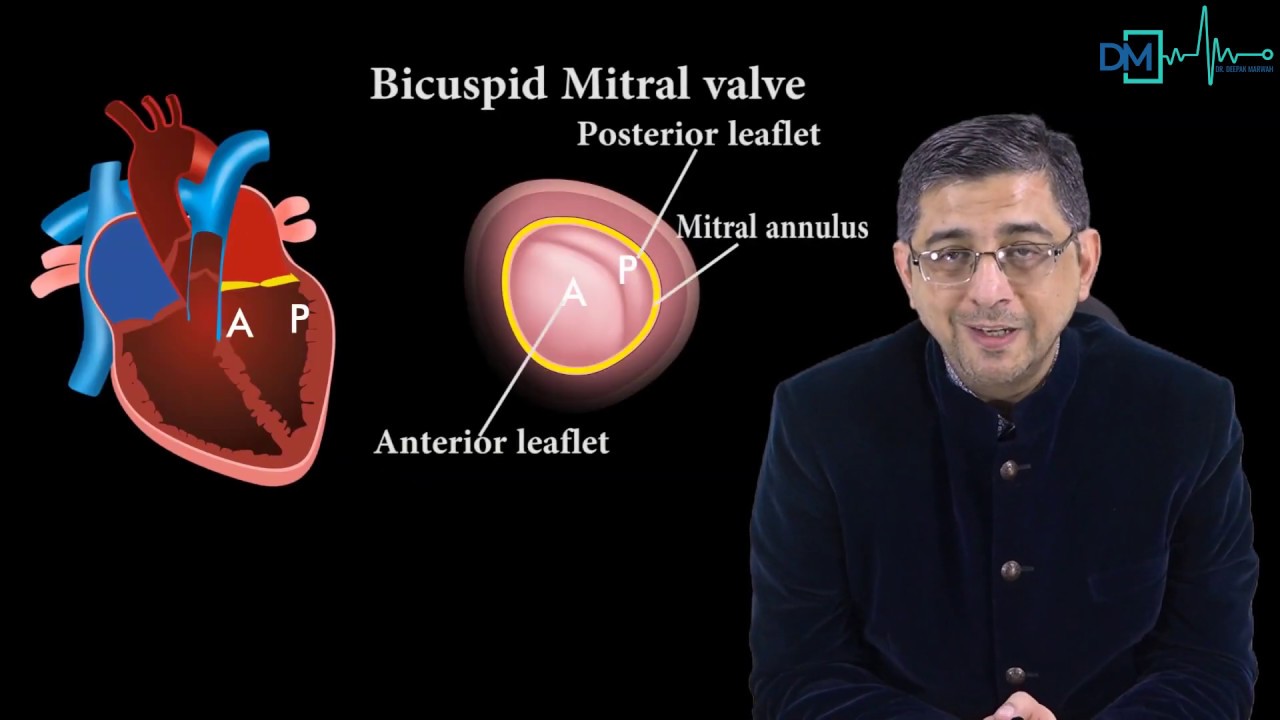Mitral Valve Prolapse - Dr. Deepak Marwah | PrepLadder |