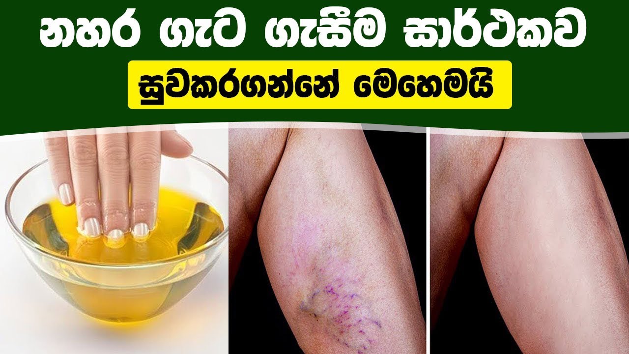 නහර ගැට ගැසීම සාර්ථකව සුවකරගන්නේ මෙහෙමයි