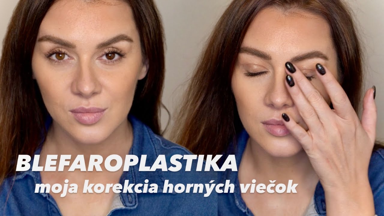 PREČO??? PRED/PO. Bolelo ma to? Priebeh zákroku, rekonvalescencia, moje tipy.