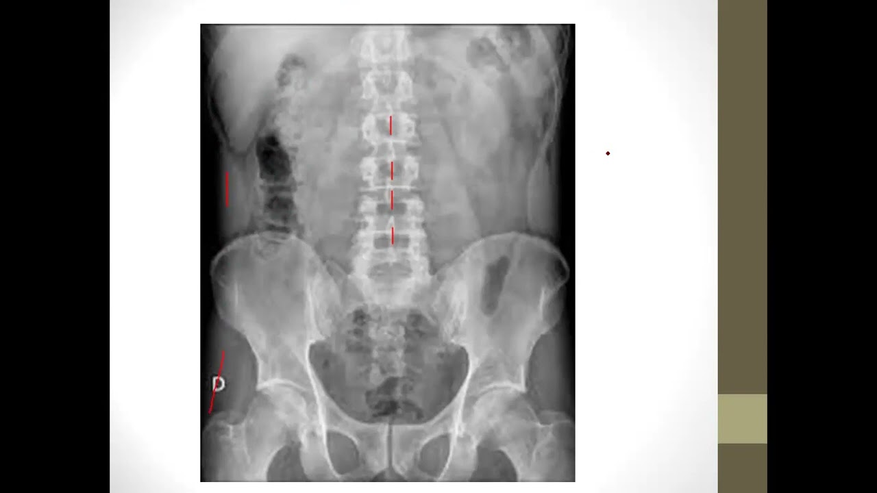RADIOGRAFIA DE ABDOMEN-DRA.NURIA GONZALEZ DUVERGE