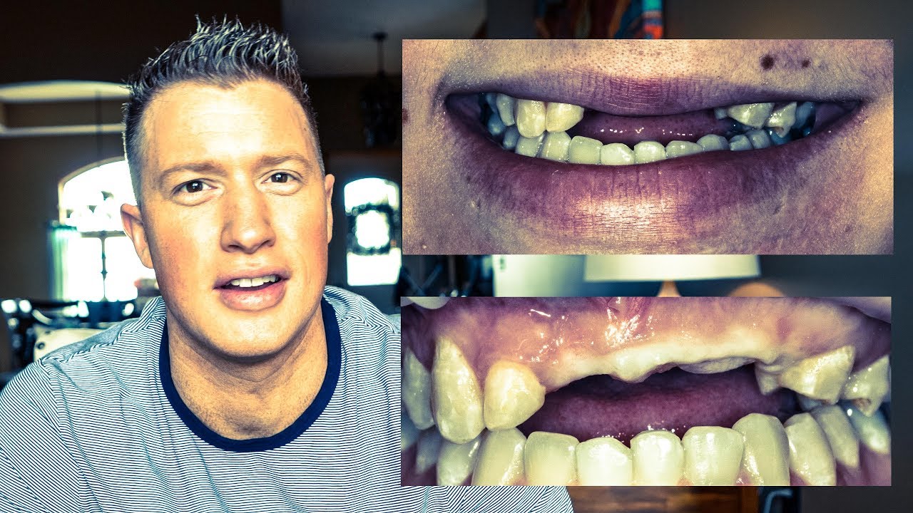 ATV WRECK leaves lady TOOTHLESS! COSMETIC DENTISTRY DENTAL IMPLANTS & VENEERS (EP 2 SMILE MAKEOVER)