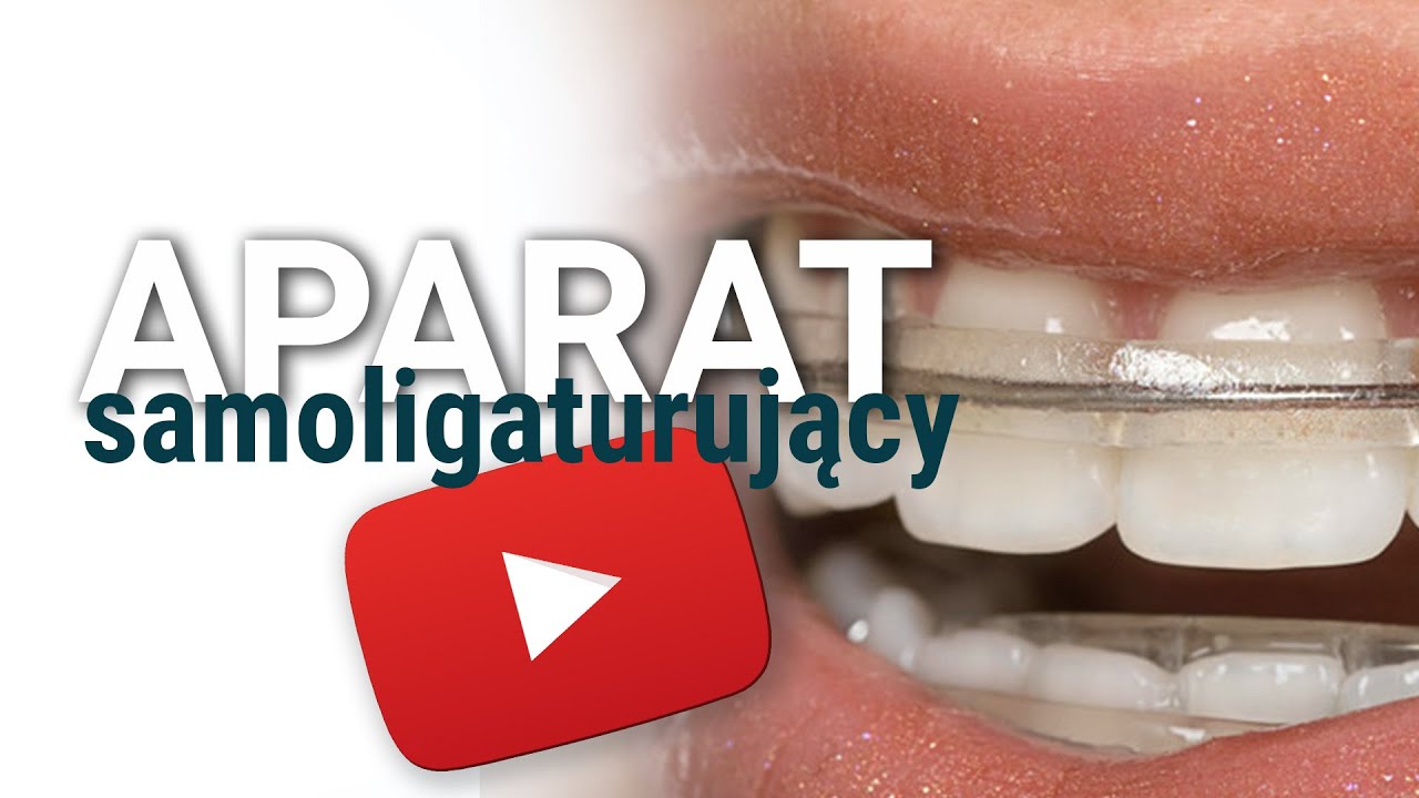 Aparat samoligaturujący - Ortodoncja Fudalej