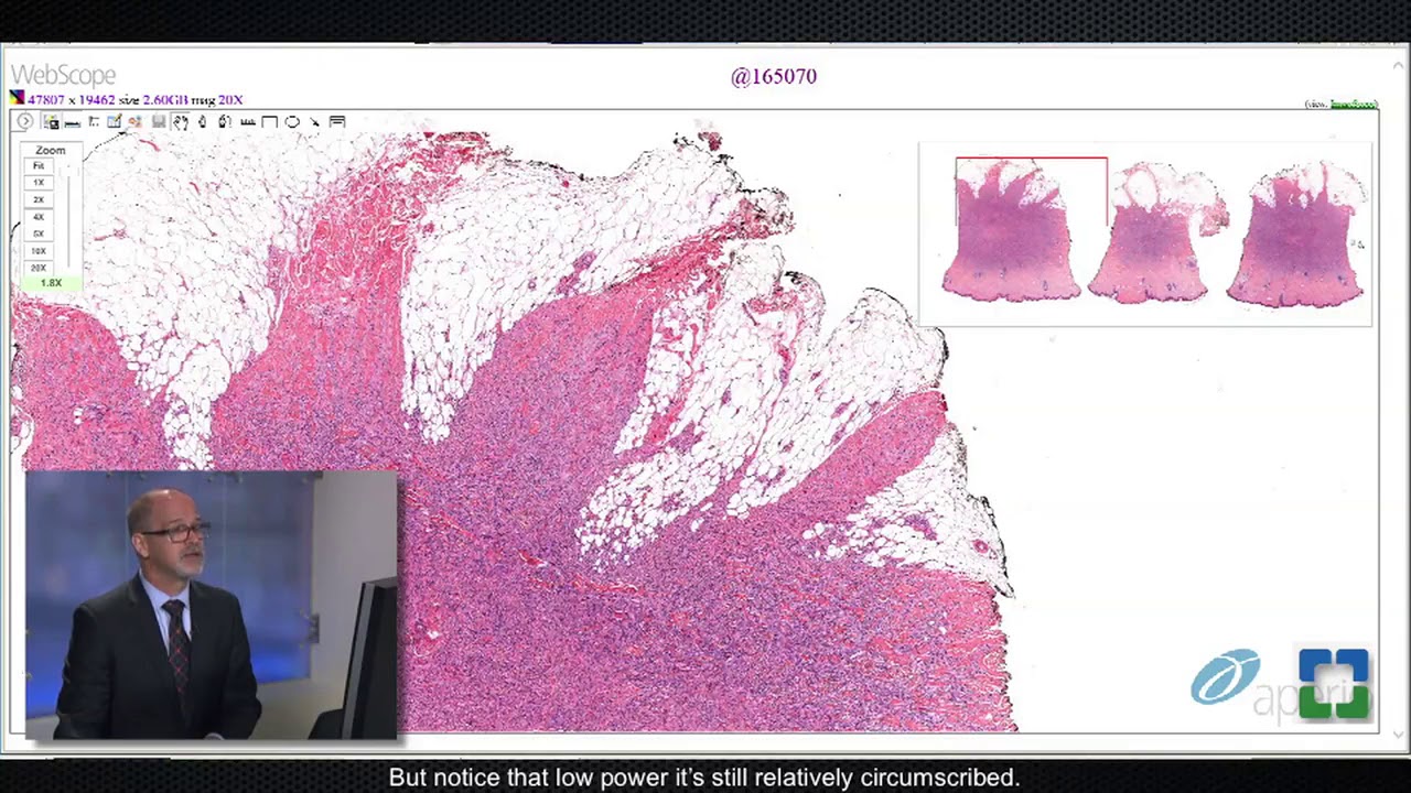 Pathology Insights: Challenging Cutaneous Spindle Cell Tumors with Steven Billings, MD