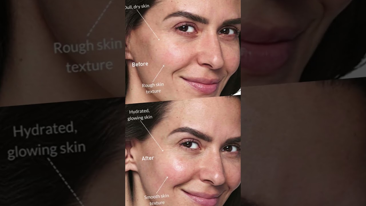 Dermal Fillers: Benefits | Ko Cosmetic Surgery Centre |  Dr. Kovarthini Cosmetic and Plastic Surgeon