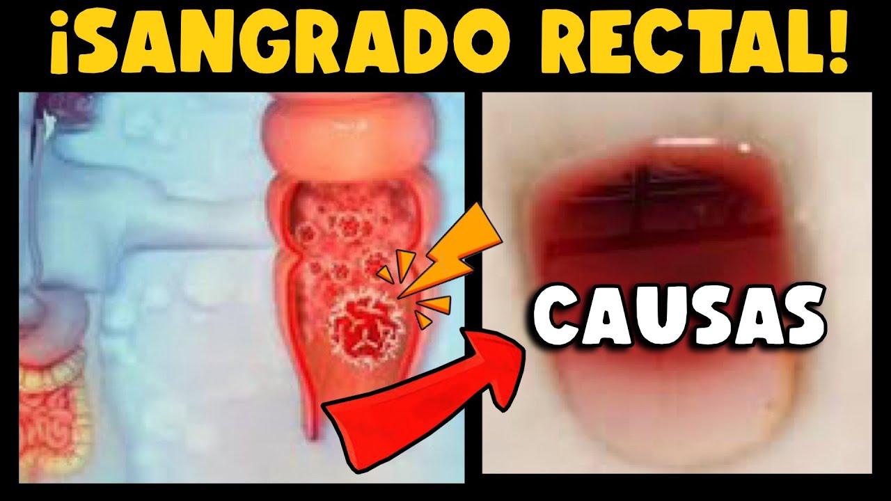 &iexcl;CUIDADO! &iquest;SANGRADO RECTAL! &iquest;CU&Aacute;LES SON LAS CAUSAS? &iquest;ES SIN&Oacute;NIMO DE C&Aacute;NCER?