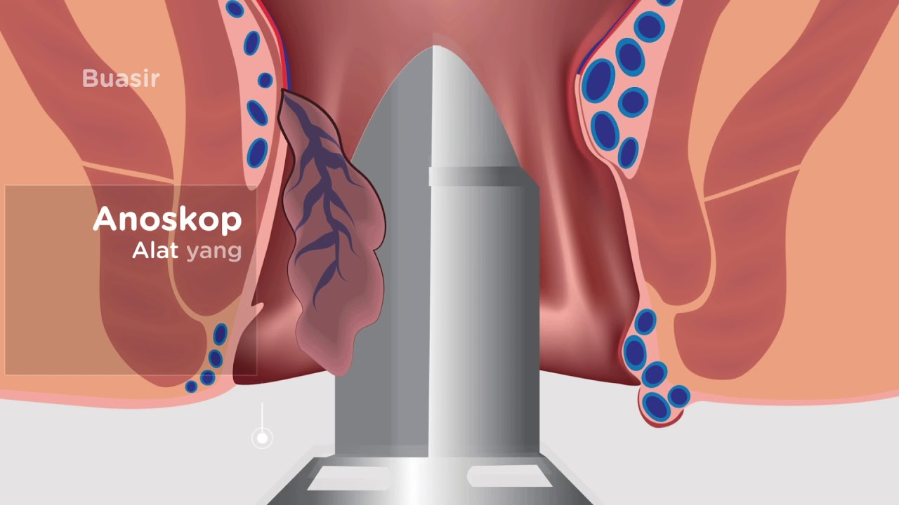 Rawatan Laser untuk Haemorrhoids (Buasir)  | Teknologi terbaru dalam merawat buasir