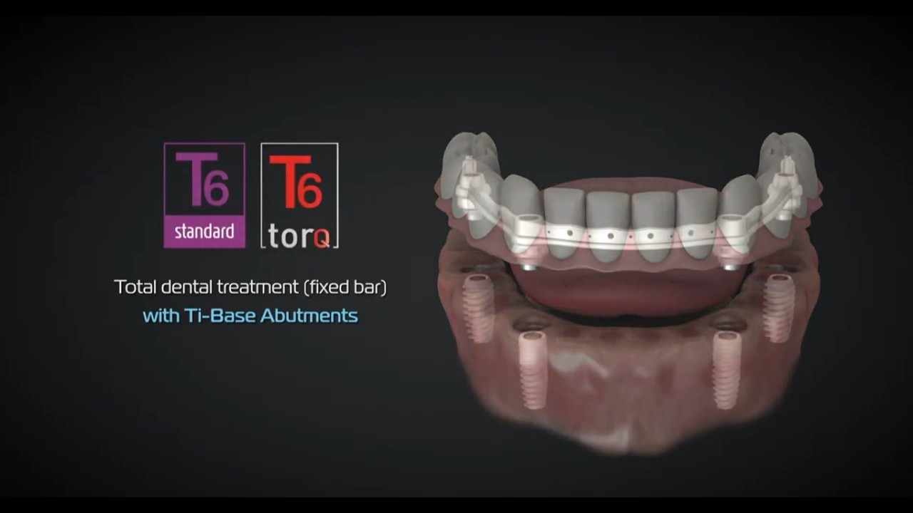 NucleOSS Ti-Base Abutments | Total Dental Treatment | Fixed Bar
