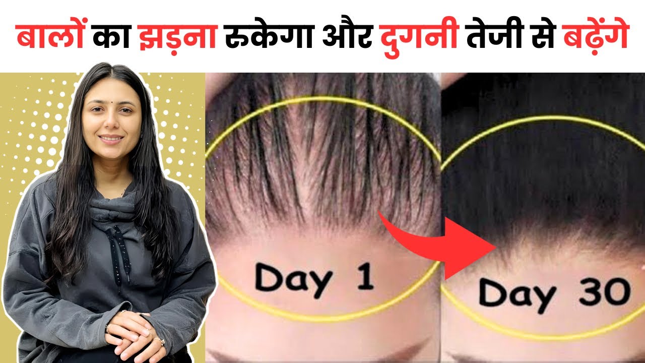 दुगनी ( 2x ) तेजी से बडेंगे बाल | Stop Hair Fall And Promote Hair Growth | बालों का झड़ना रोके