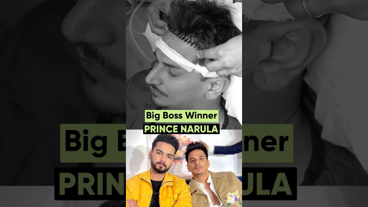 Reality Show King Prince Narula Hair Transplant Surgery | Latest Fue Technique #shorts #viral