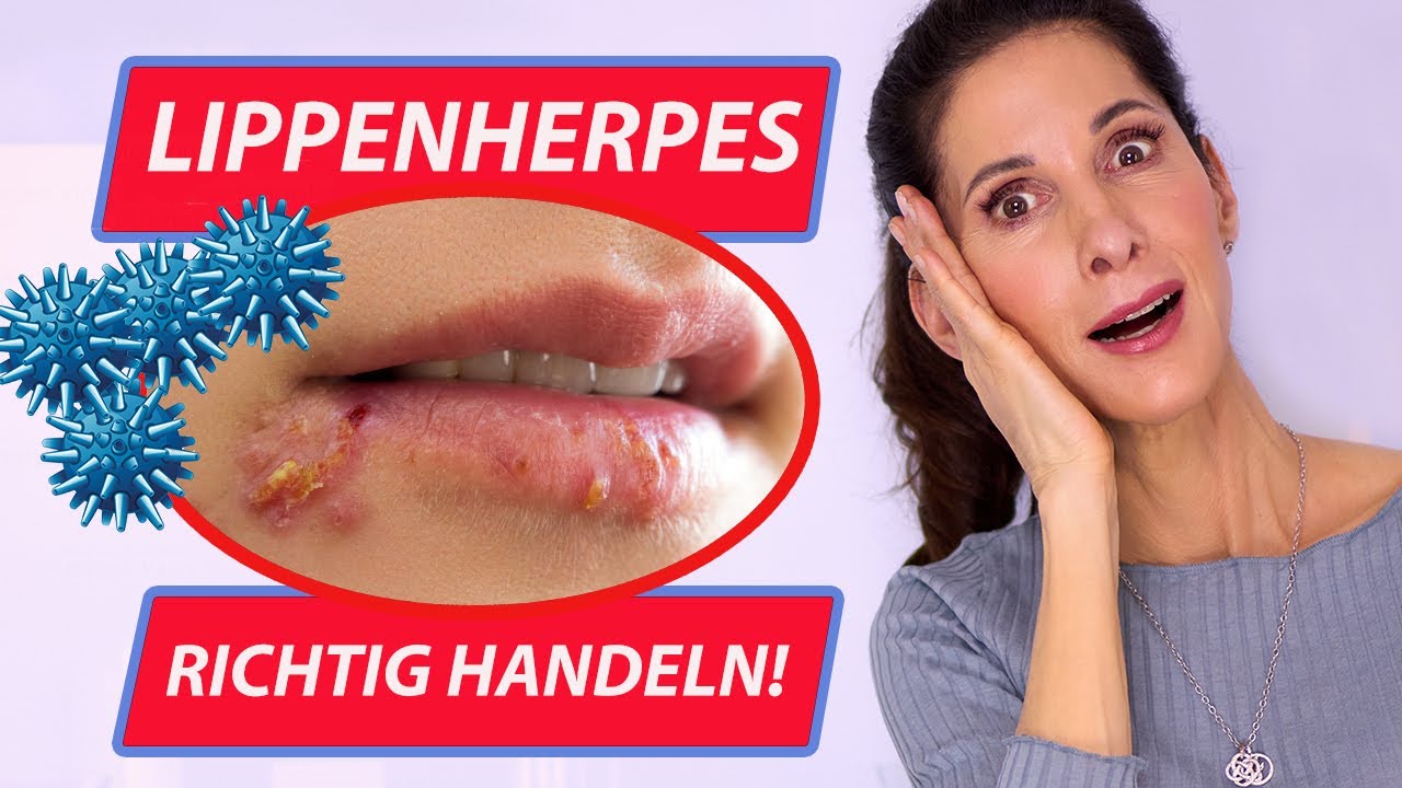 Lippenherpes - Es kann jeden treffen - Schlafende Viren - Das musst Du wissen!  | Doktor Julie