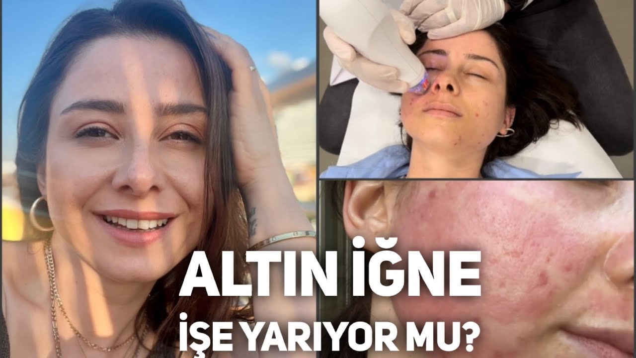 Altın İğne Tedavisi 💉✨/ Sivilcelerde etkili mi? İşlem Hakkında Merak Edilenler