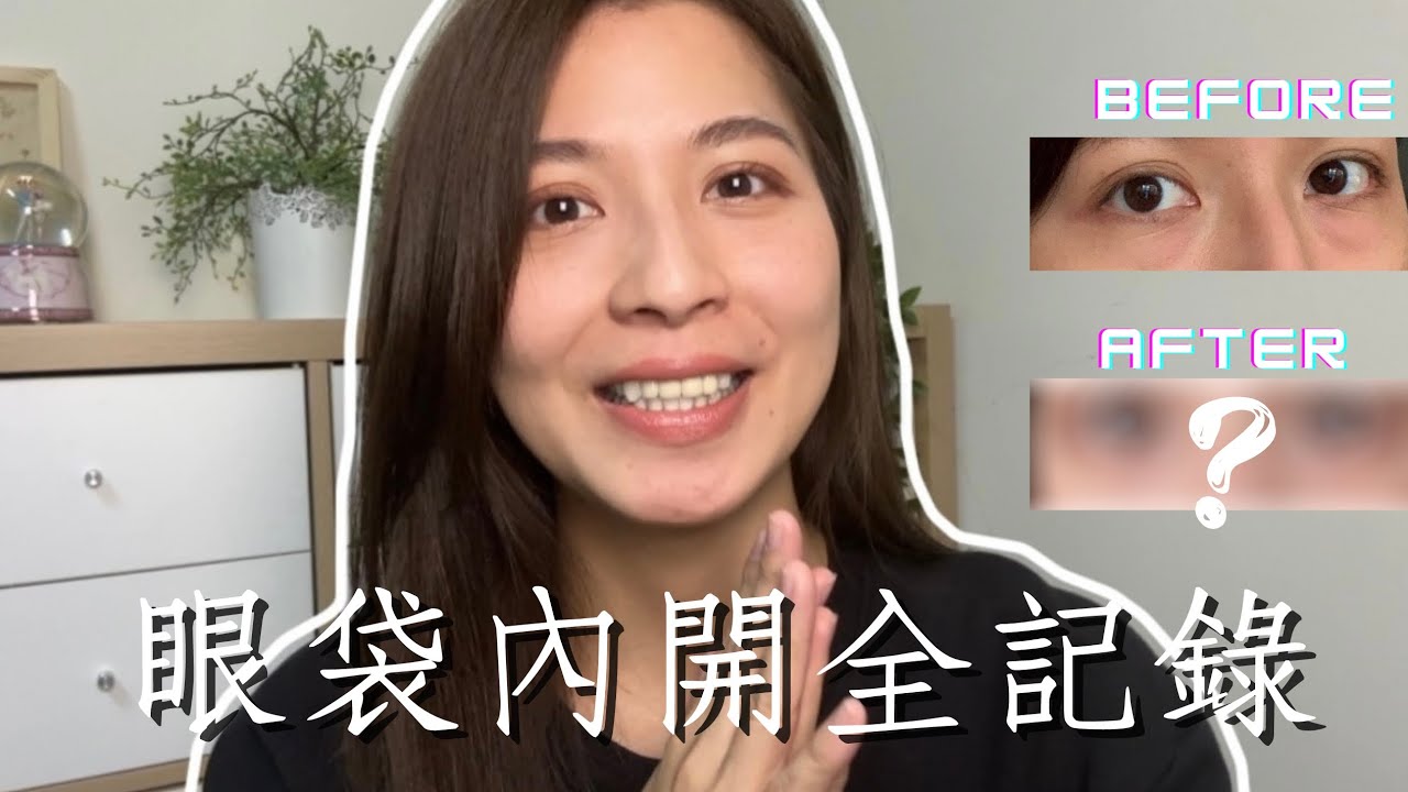 後悔太晚做了！眼袋內開手術全記錄｜修復期多久？/值不值得？/會痛嗎？|王安 Ann Wang