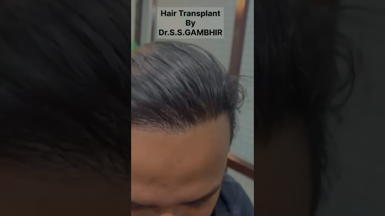 2 years after Hair transplant by Dr Gambhir in New Delhi Sir Ganga Ram Hospital