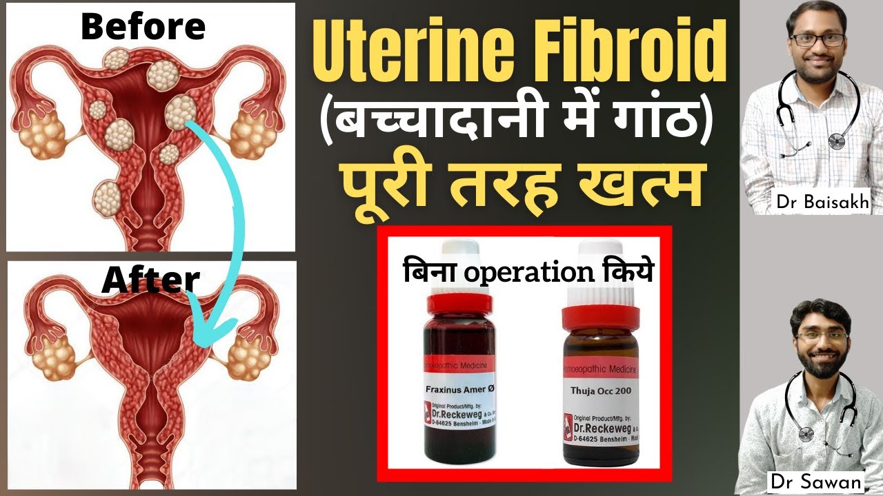 Homeopathic medicine for uterine fibroids- uterine fibroid treatment without operation