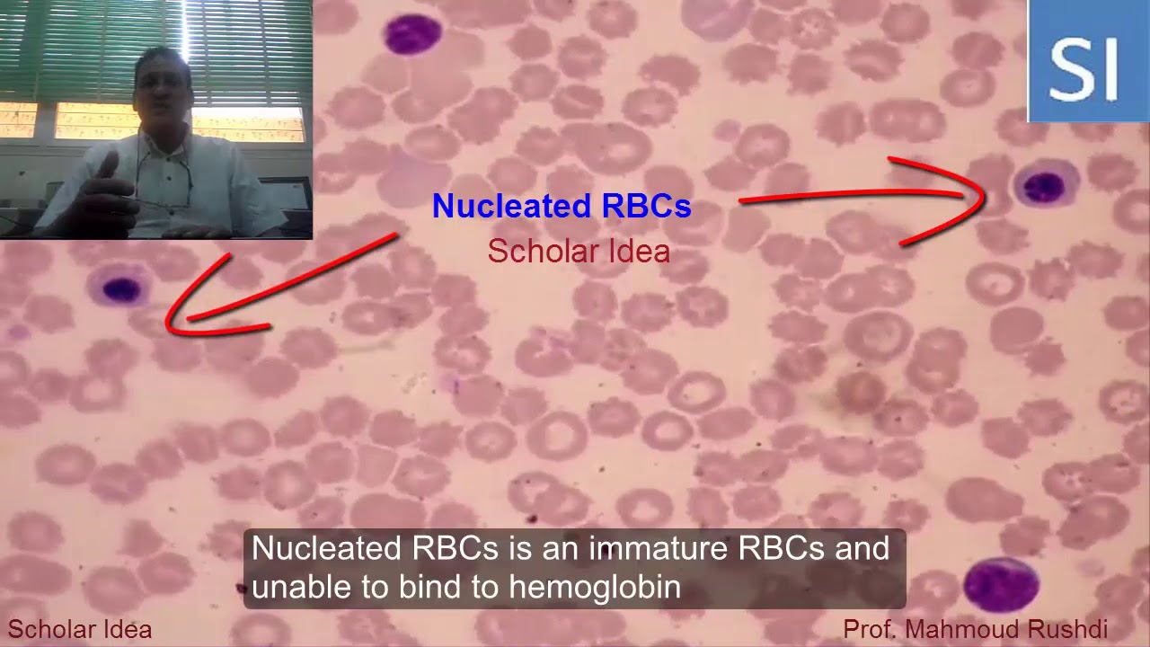 Nucleated red blood cells in the peripheral circulation !!!