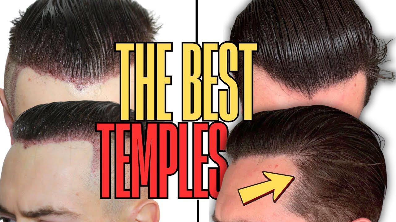 How to Spot ELITE Temple Work in Hair Transplants (Avoid Botched Results)