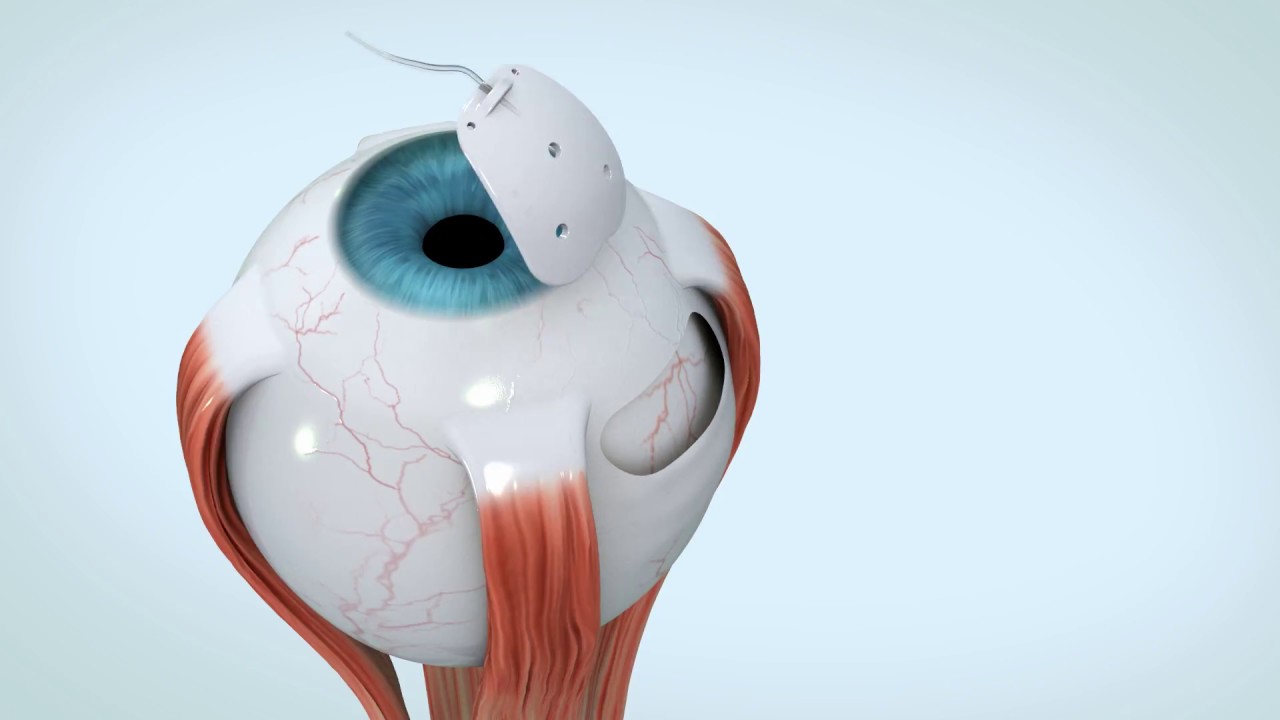 Video animation of the eyeWatch system