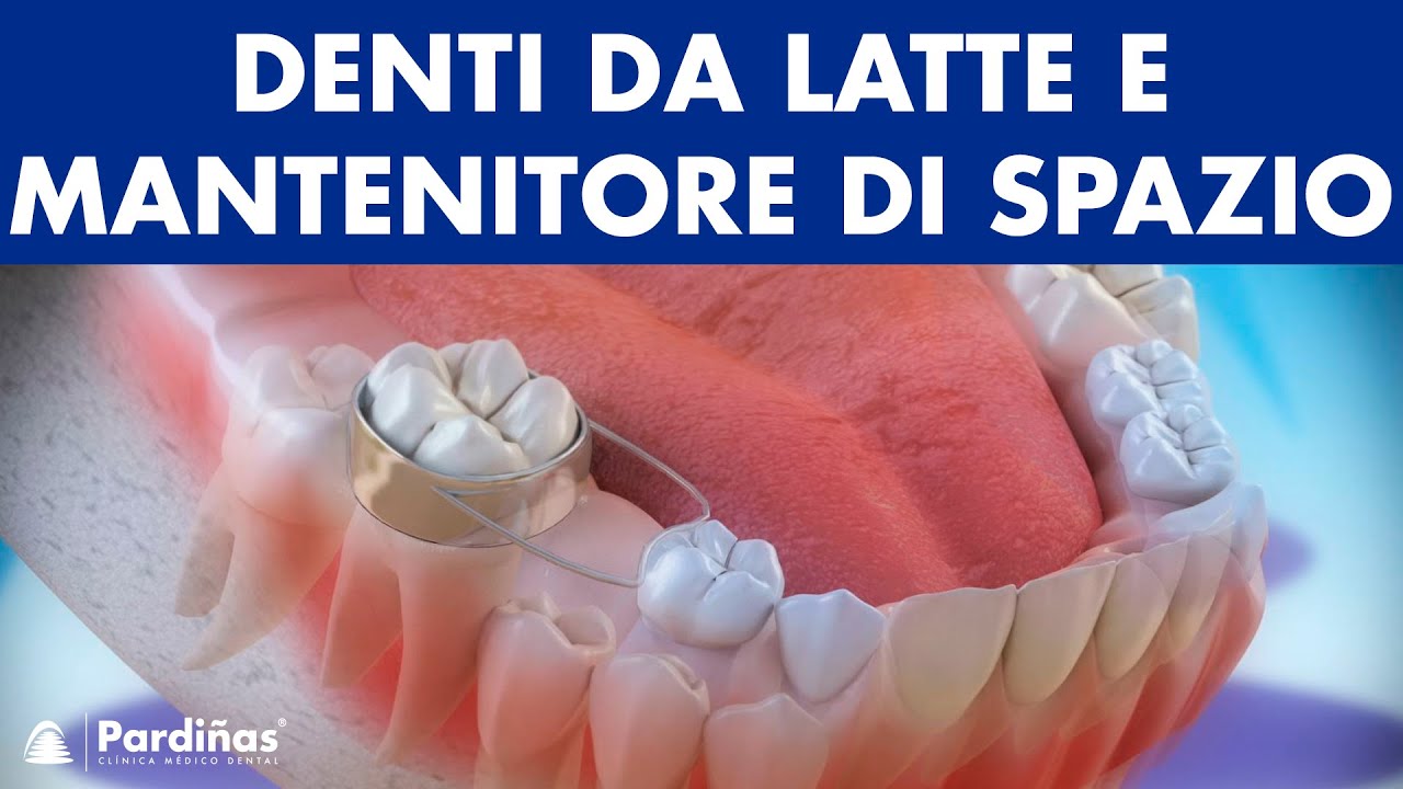 Denti da latte e’l uso del mantenitore di spazio ©