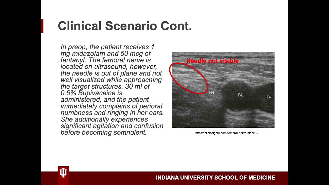 A Case of Local Anesthetic Systemic Toxicity (LAST) by Adam Warrick, MD Candidate Class of 2022