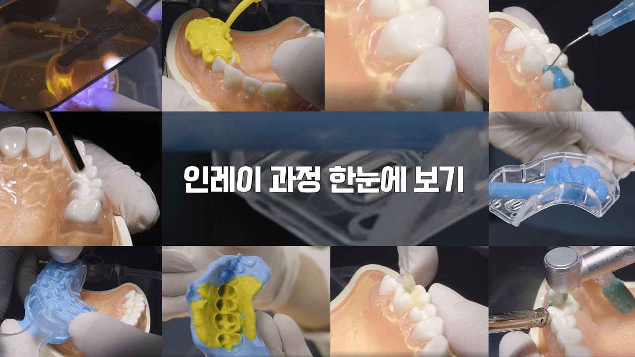 인레이로 충치 치료 하는 과정 자세하게 들여다보기