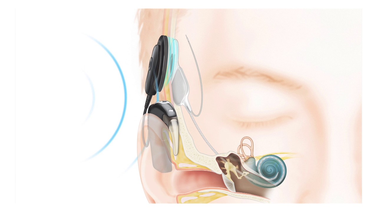 Patient&rsquo;s hearing is remarkably improved thanks to cochlear implant
