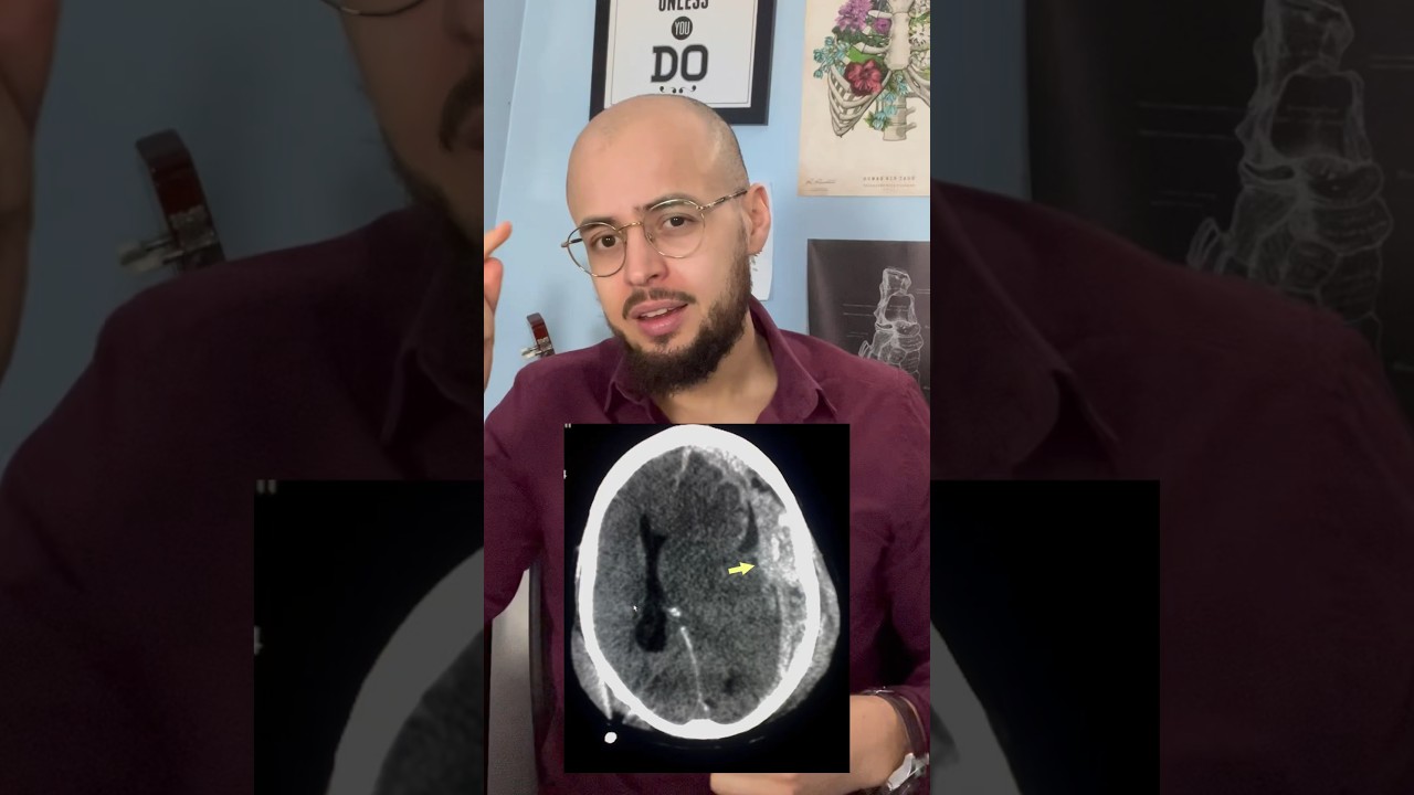 Du sang au niveau du cerveau : h&eacute;matome sous dural et extra dural