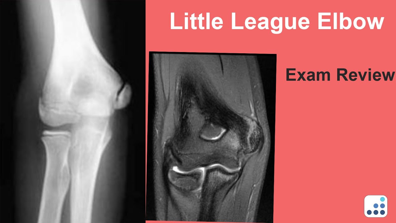 Little League Elbow Exam Review - Christopher S. Ahmad, MD