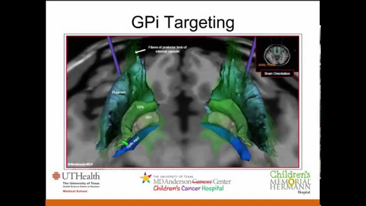 Spastic Cerebral Palsy - Dr. Manish Shah