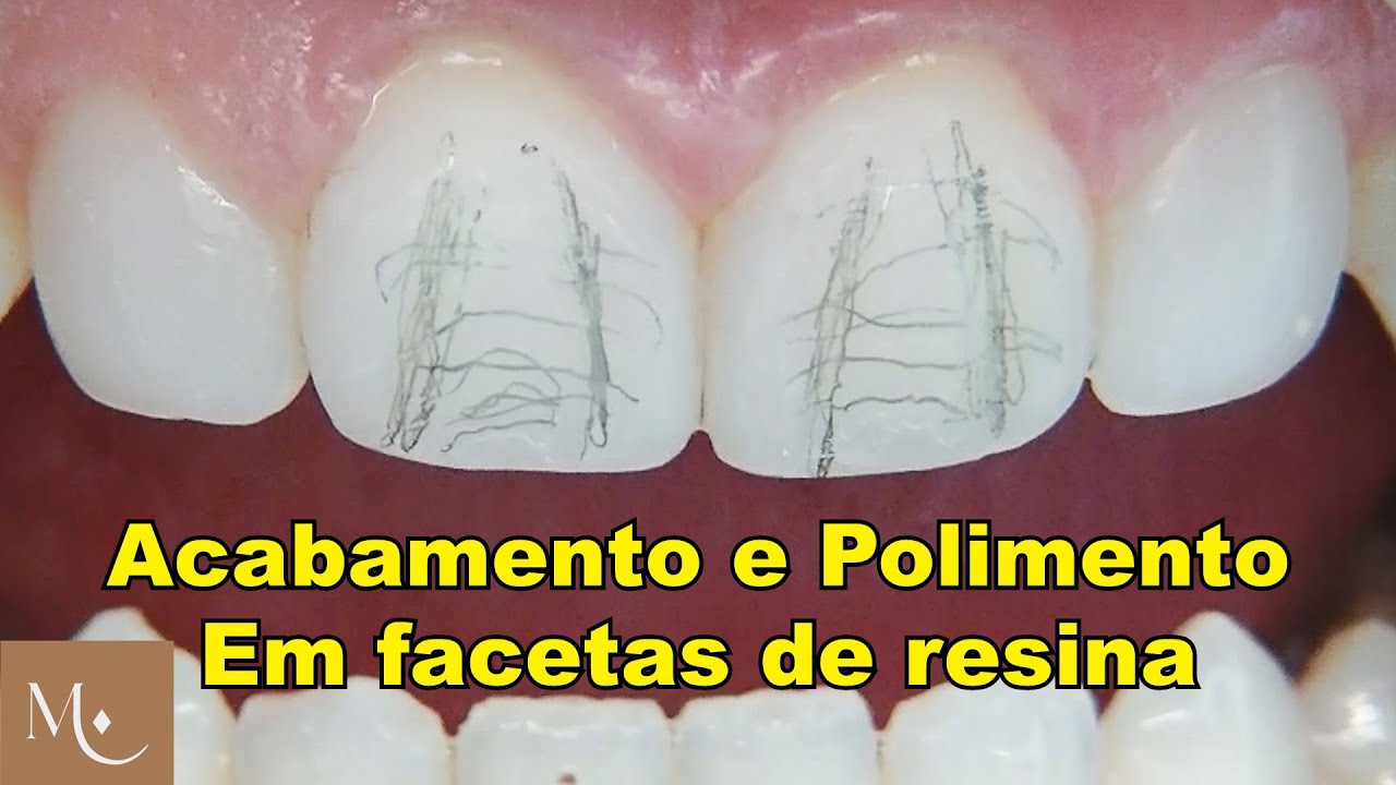 Acabamento e Polimento em facetas de resina