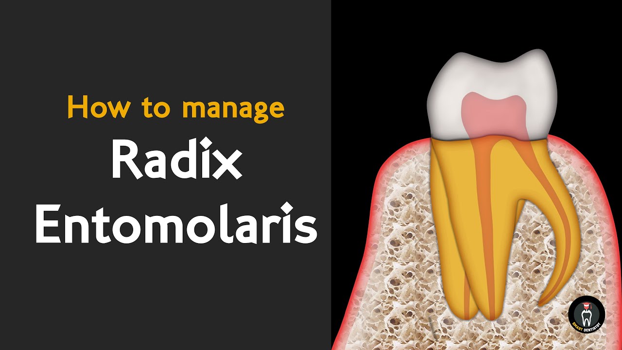 Radix entomolaris | Простая техника