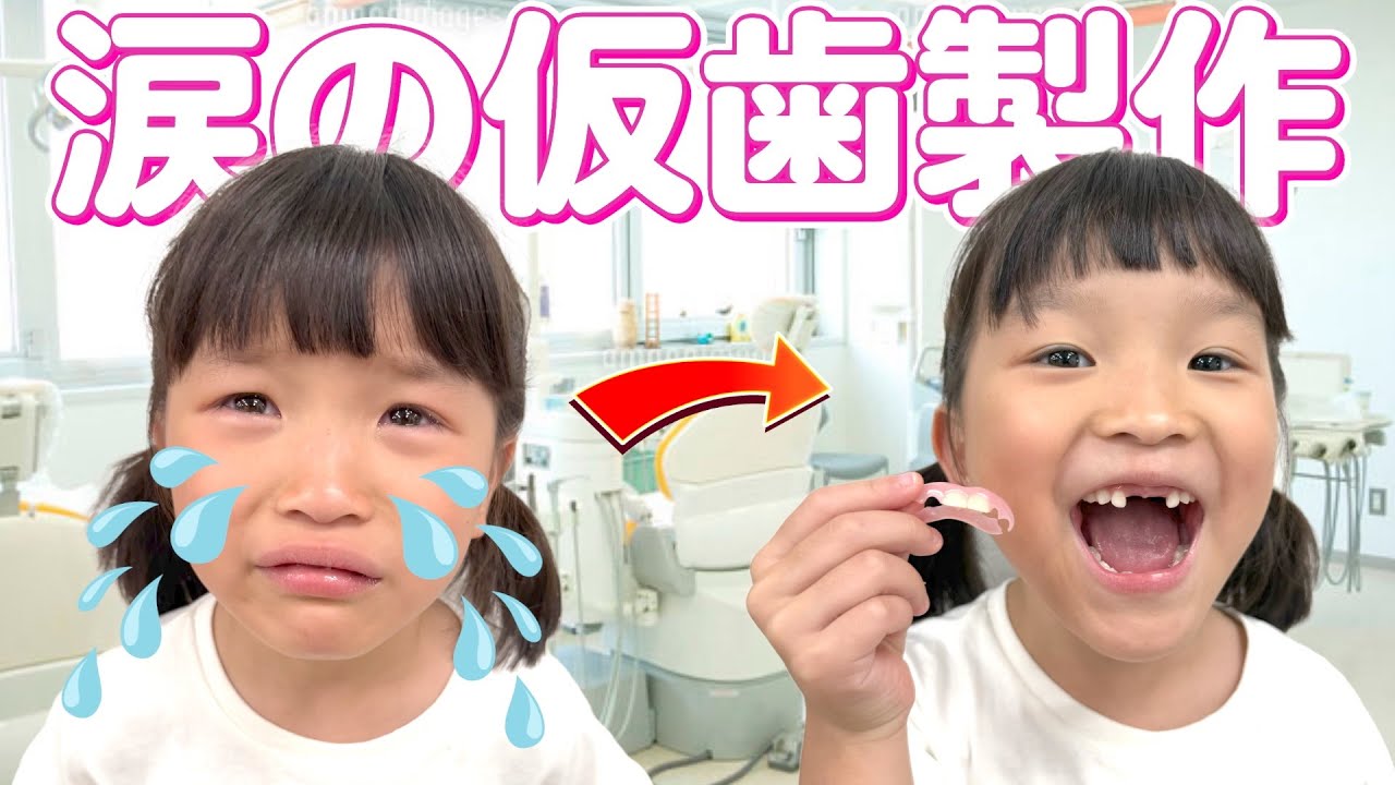 【仮歯作り】歯医者さんはやっぱり怖かった…?!🥹 
