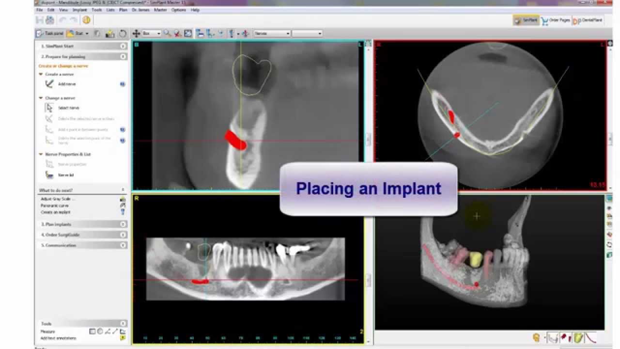 SIMPLANT Introduction to 3D Surgical Guide Modeling