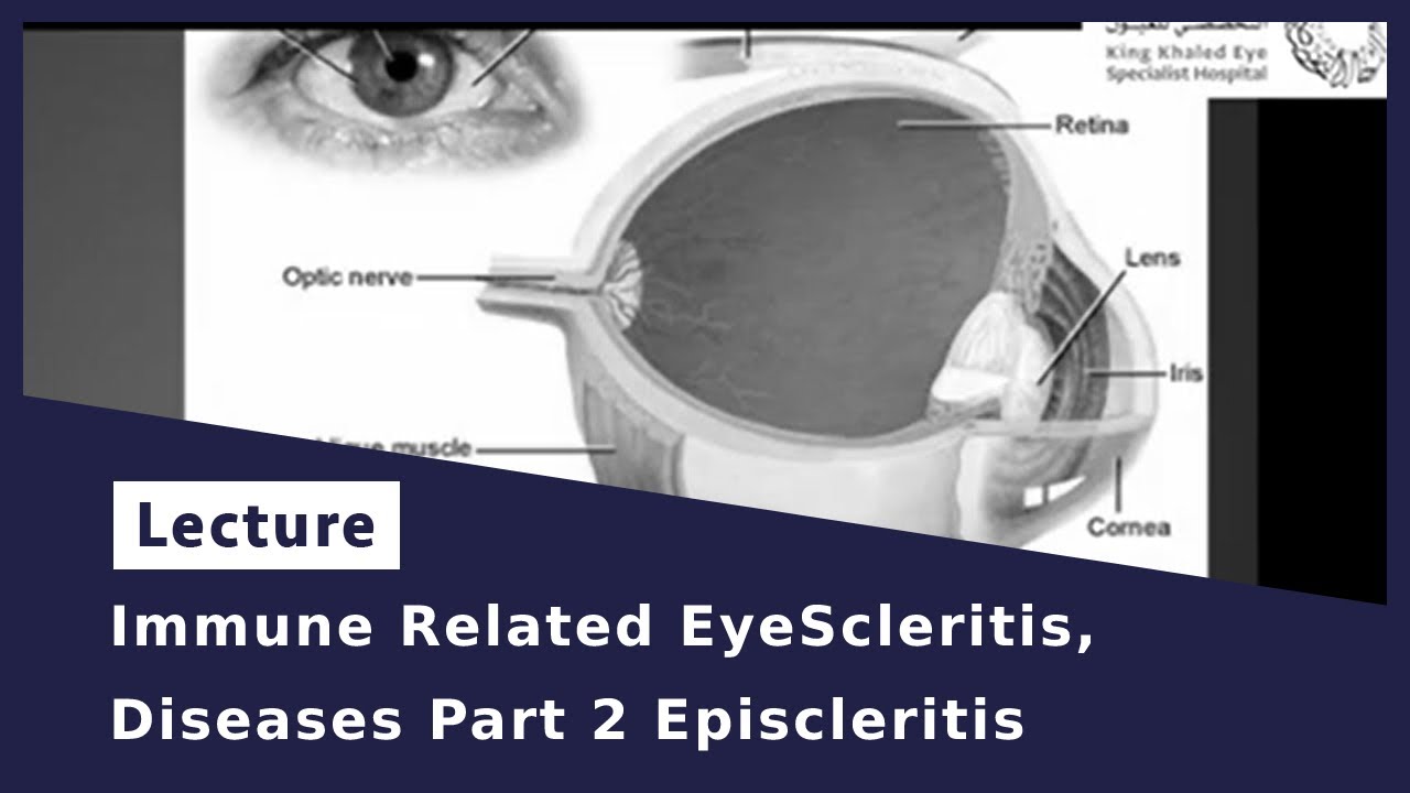 Immune Related EyeScleritis,Diseases Part 2 Episcleritis
