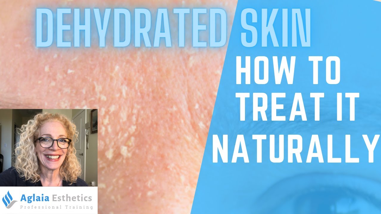 DEHYDRATED SKIN | HOW TO TREAT IT | NATURALLY!