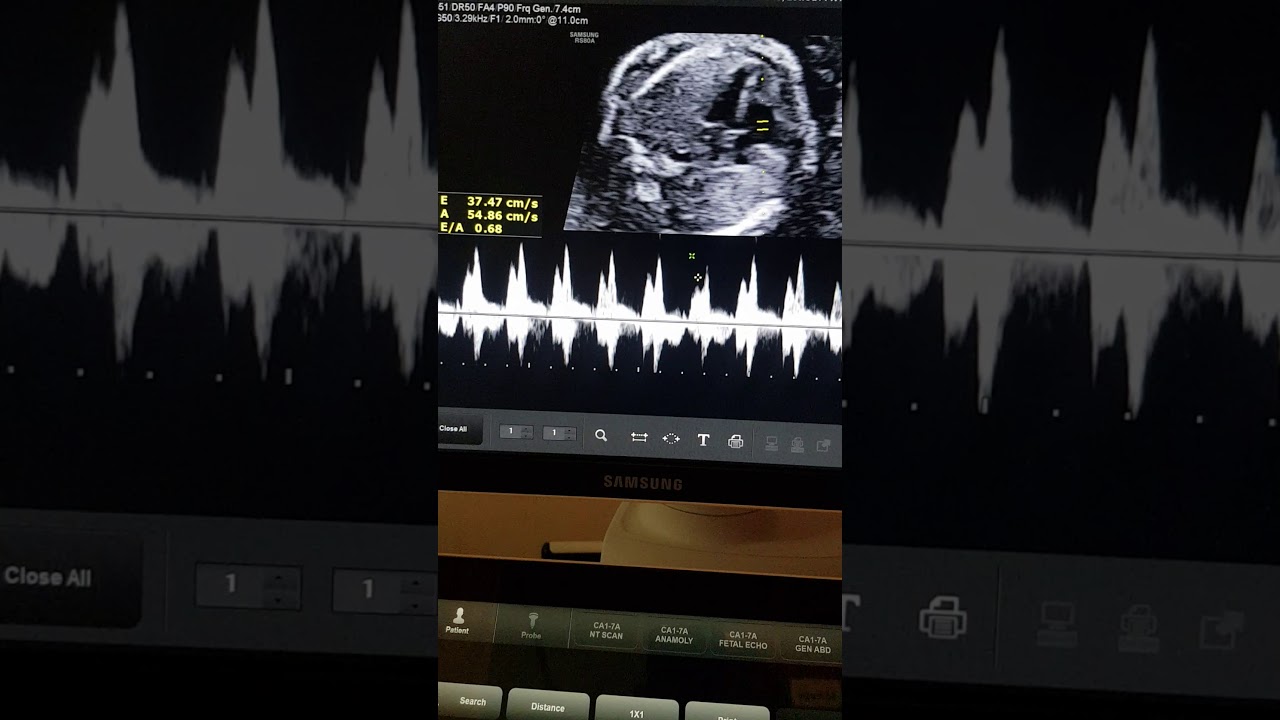 Fetal echo evolving coarctation of AORTA /LSVC teaching by Dr Pradeep Srinivasan  REFER SERIES