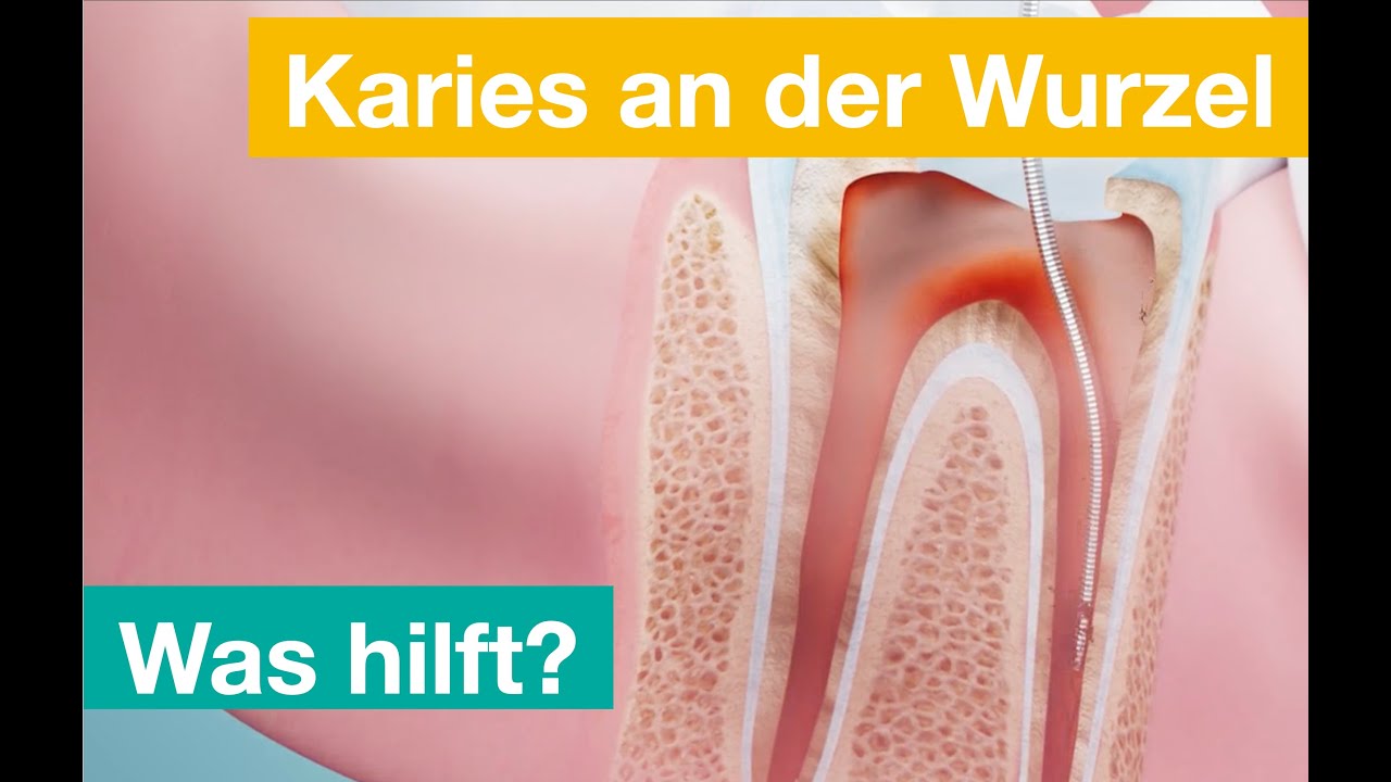 Wurzelbehandlung
