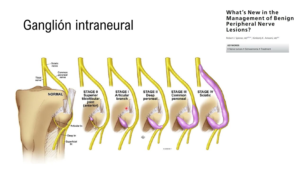 Quiste peroneal: ventajas del estudio simultáneo con electromiografia y ecografía