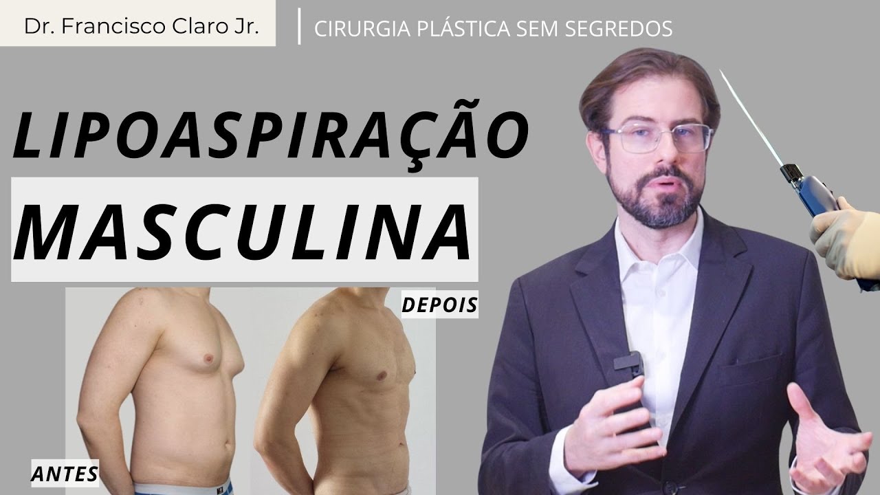 A Lipoaspiração Masculina é igual à lipoaspiração feita em mulheres?