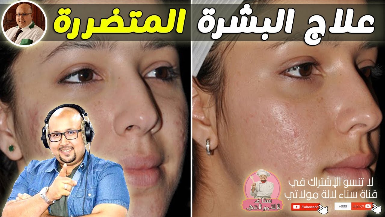 ترميم البشرة المتضررة من الوصفات الضارة والعشوائية من عند الدكتور عماد ميزاب imad mizab