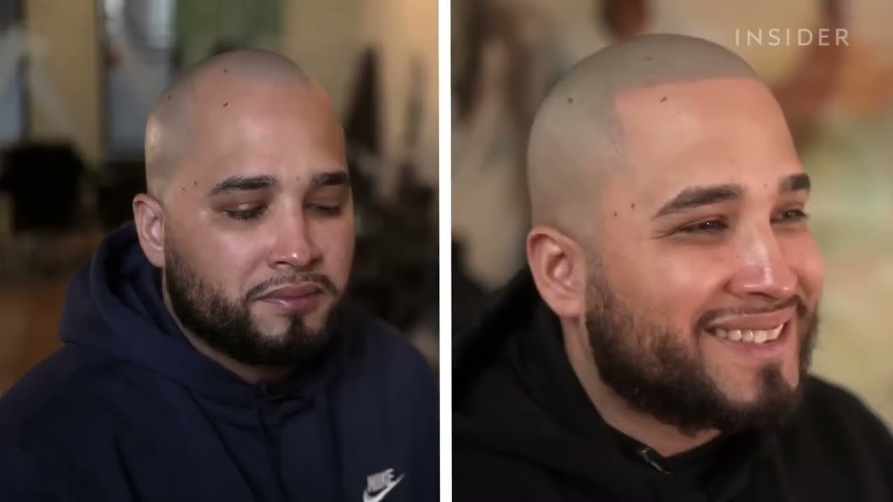 My Scalp Micropigmentation Experience