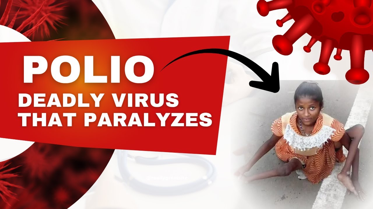 Polio &ndash; How It Spreads & Affects the Nervous System&nbsp;Explained