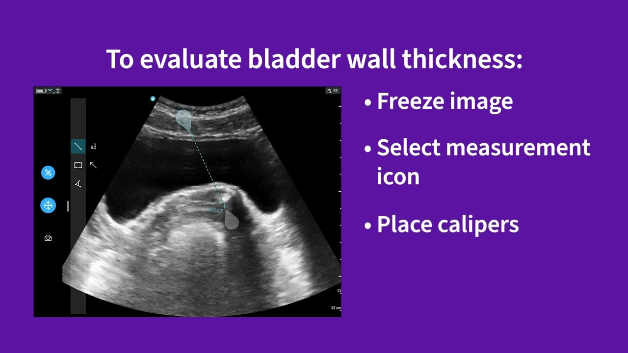 Vscan Air™ | Using presets for evaluations: bladder