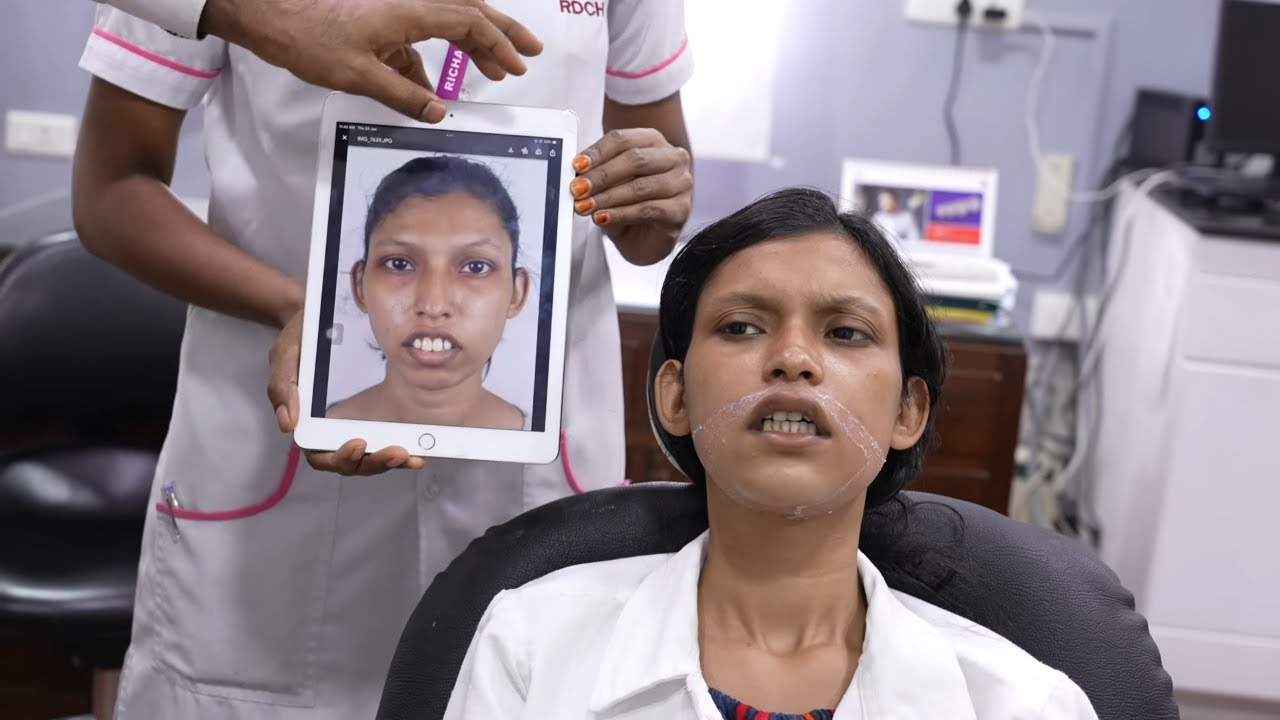 Amazing Jaw Transformation in Bijaw Surgery | Gummy Smile | Before and After Surgery