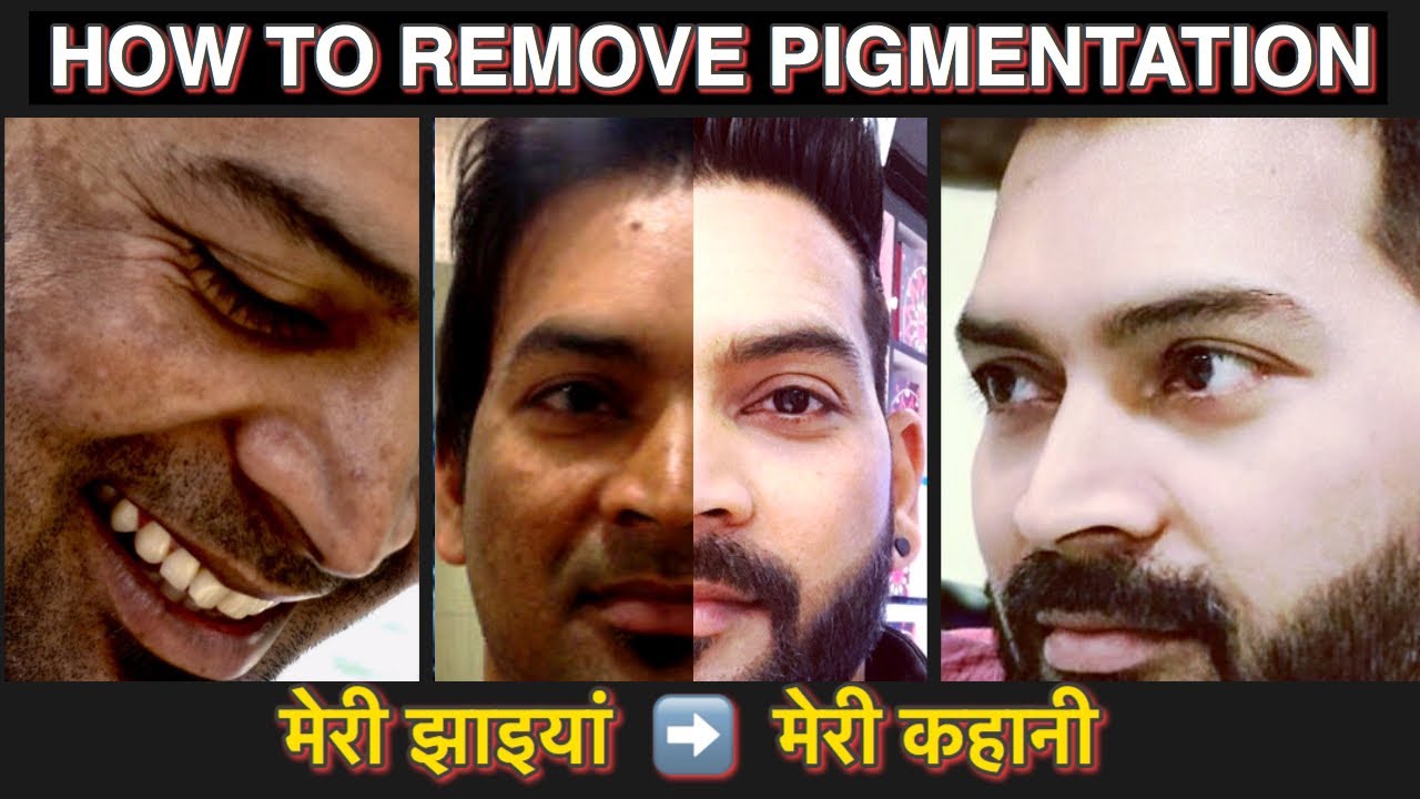 How to Remove PIGMENTATION (Melasma) Naturally. मेरी झाइआ, मेरी कहानी