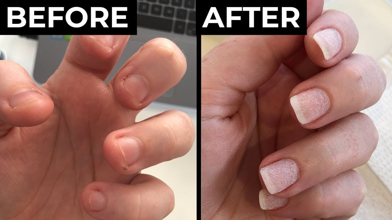 Exactly How I Stopped Biting My Nails