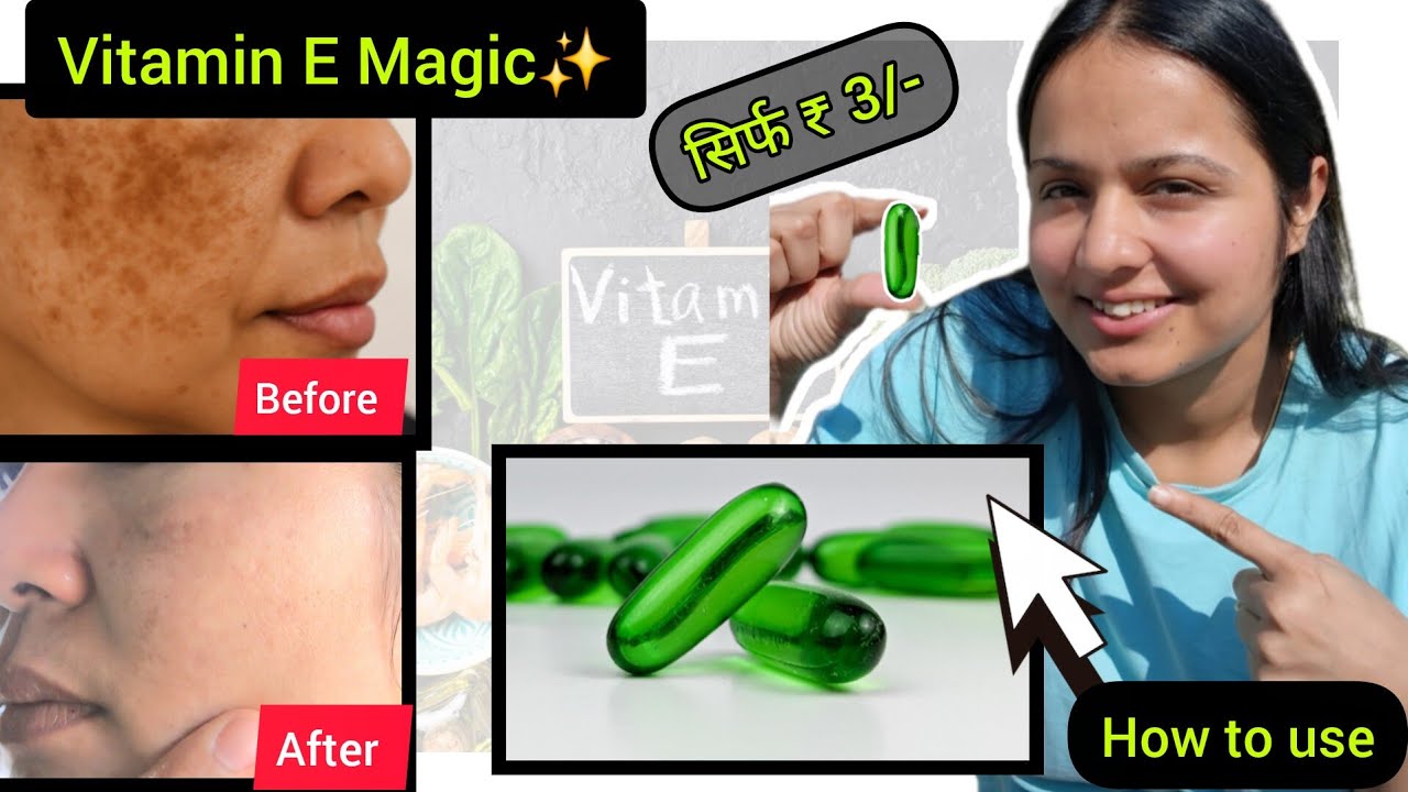 3 रुपए की Vitamin E se झाइयां, dry dull skin (रुखी-बेजान त्वचा) Open pores, Pigmentation गायब✨️✨️