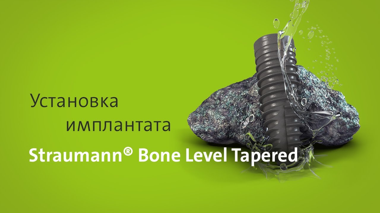 Установка имплантата: Straumann® Bone Level Tapered