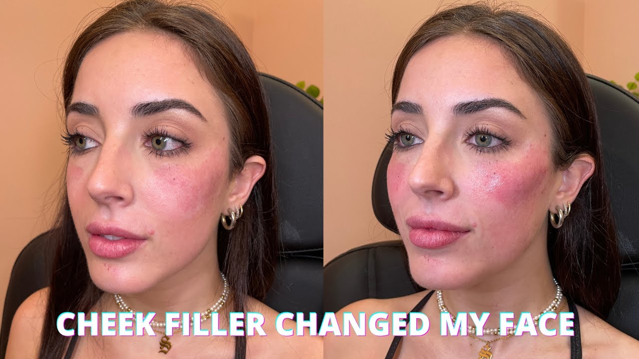 Watch me get cheek filler !! My experience, before & after Juvederm Voluma